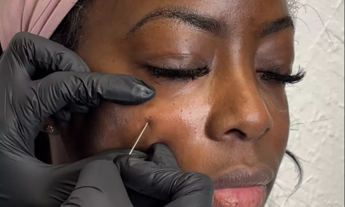Under Eye Restoration Session with PRP Treatment