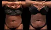 Sculpt Your Body w/ 2 or 3 Fat Dissolver Sessions or 1 Fat Dissolver and More at Southern Shapez (Up to 50%Off)
