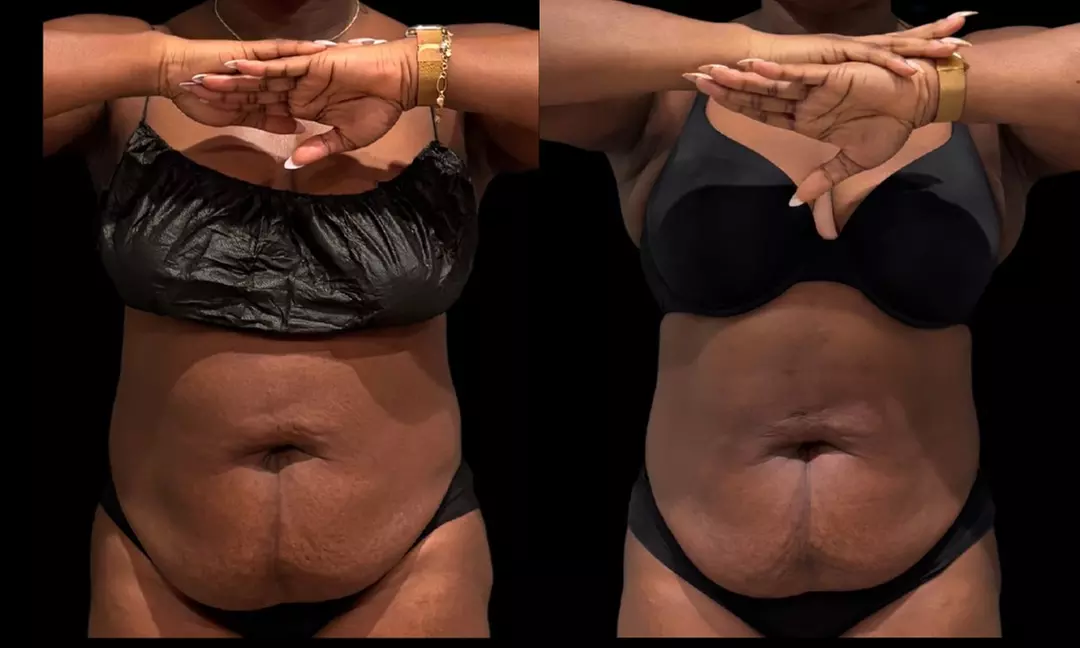 Sculpt Your Body w/ 2 or 3 Fat Dissolver Sessions or 1 Fat Dissolver and More at Southern Shapez (Up to 50%Off) - Primary Image