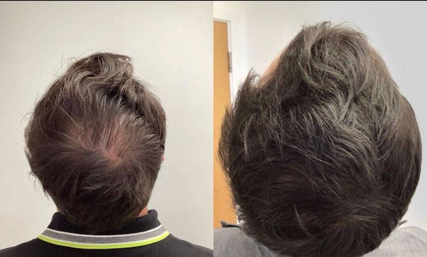Image 2: Rejuvenate with One or Four Sessions of PRP Hair Restoration