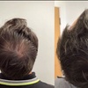 Image 2: Rejuvenate with One or Four Sessions of PRP Hair Restoration
