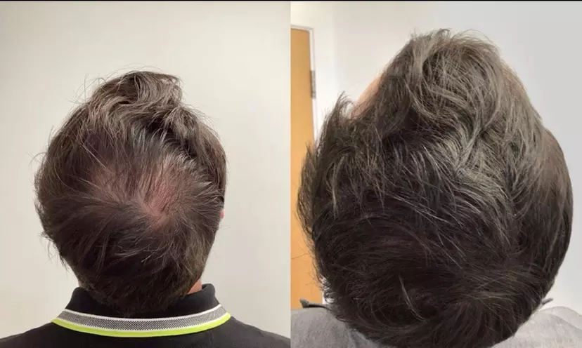Rejuvenate with One or Four Sessions of PRP Hair Restoration