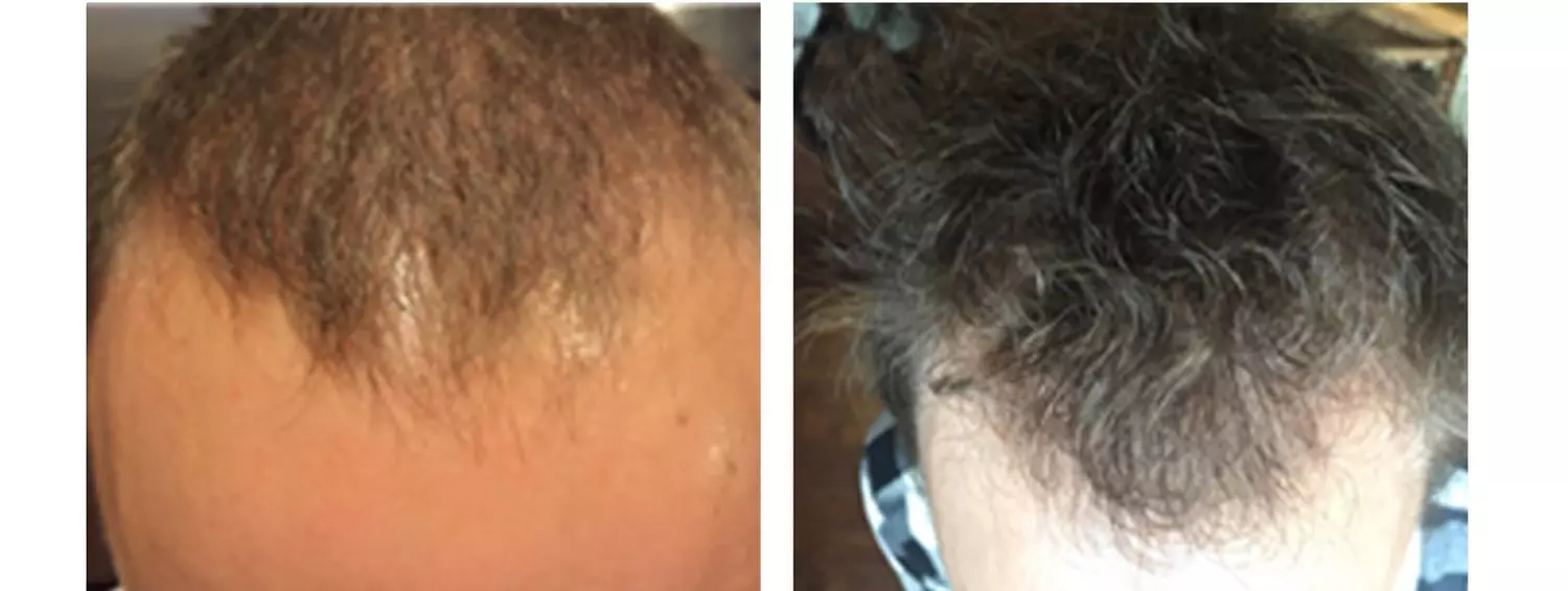 27% Off Hair Restoration - Other - Second Medium
