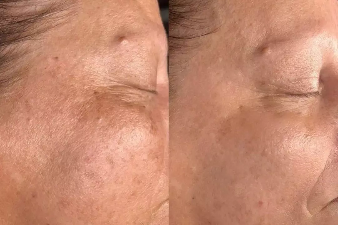 $62.50 For A 30-Minute Pro Power Peel (Reg. $125)