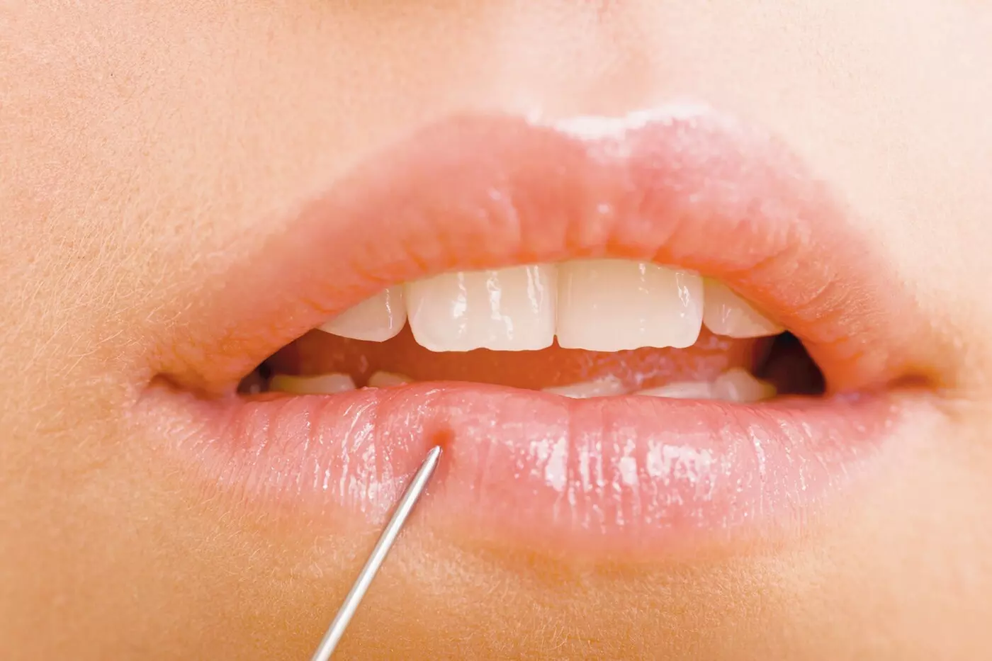 $449 For 1 Juvederm Ultra Injectable Filler W/ Facial Consultation ...