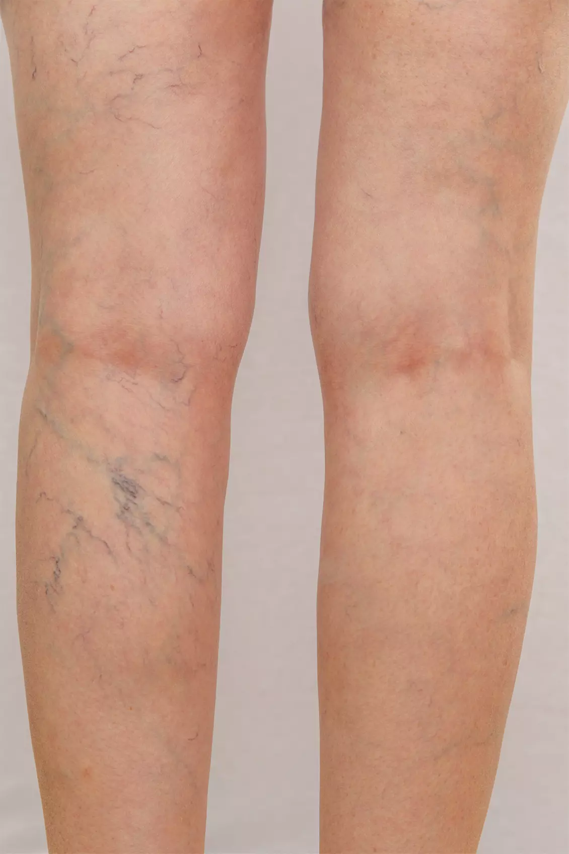 $74.50 for one 20-minute Sclerotherapy Vein Session ($200 value) - Second Medium