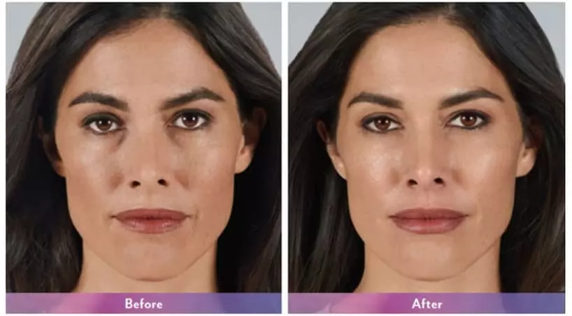 $449 For 1 Juvederm Ultra Injectable Filler W/ Facial Consultation ...