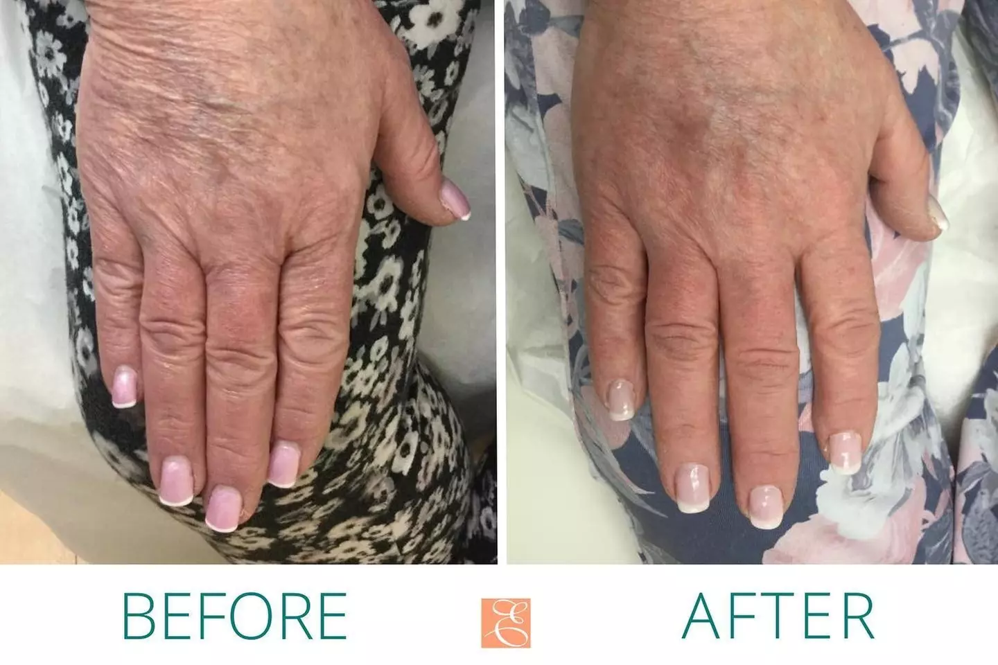 $75 For $150 Toward Toxin, Fillers, & Threads.