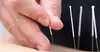 $49 For One Hour Initial Private Acupuncture (Reg. $98)