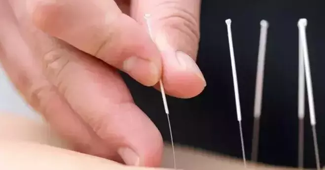$49 For One Hour Initial Private Acupuncture (Reg. $98) - Primary Image