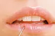 $449 For 1 Juvederm Ultra Injectable Filler W/ Facial Consultation (Reg. $900) - Second Medium