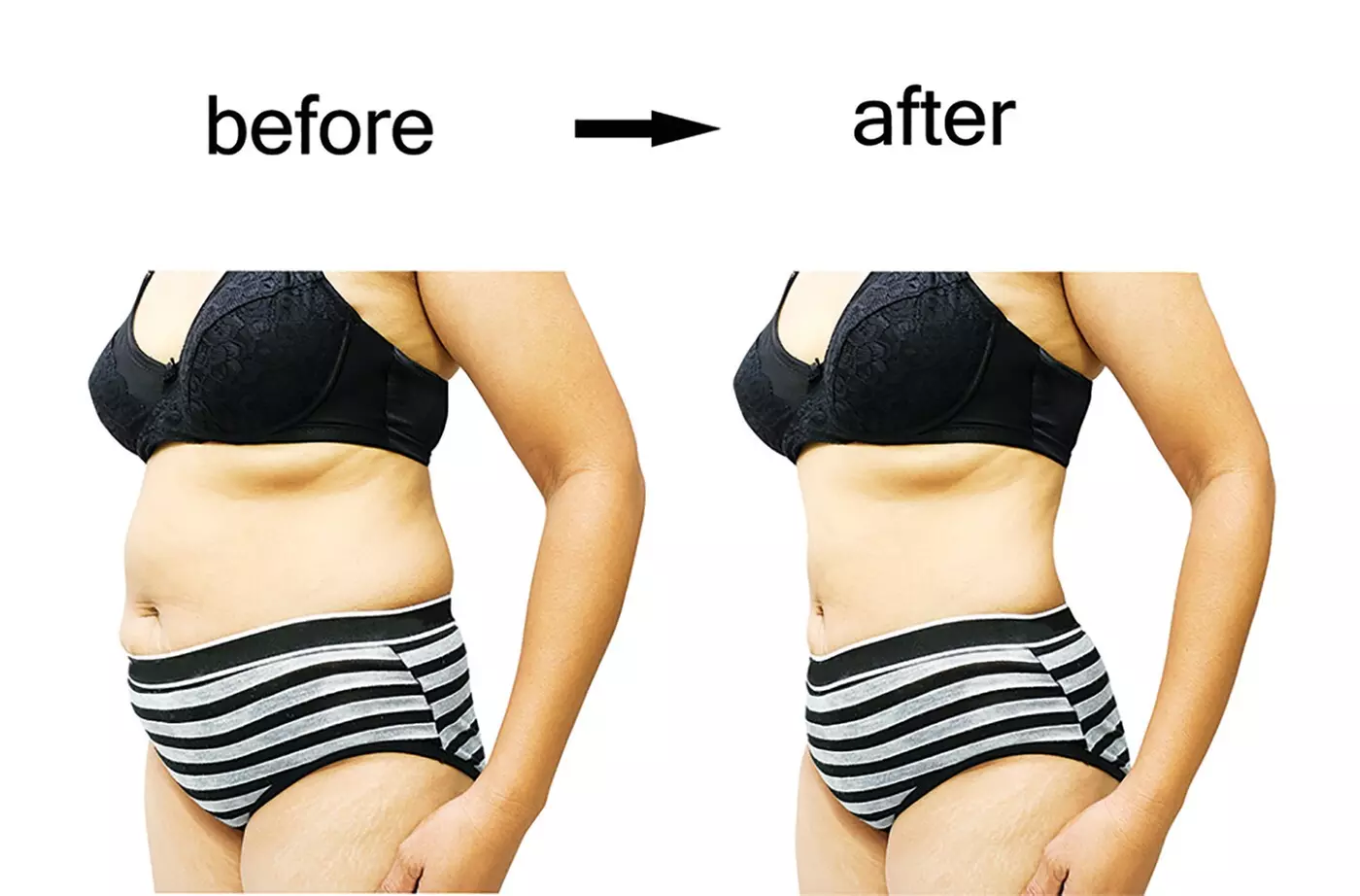 $499 For 1-Cycle Of FDA Cleared Coolsculpting Elite (Reg. $1000) - Second Medium