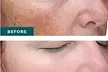 $75 For A Customized Facial (Reg. $150) - Second Medium