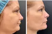 $75 For $150 Toward Toxin, Fillers, & Threads. - Second Medium
