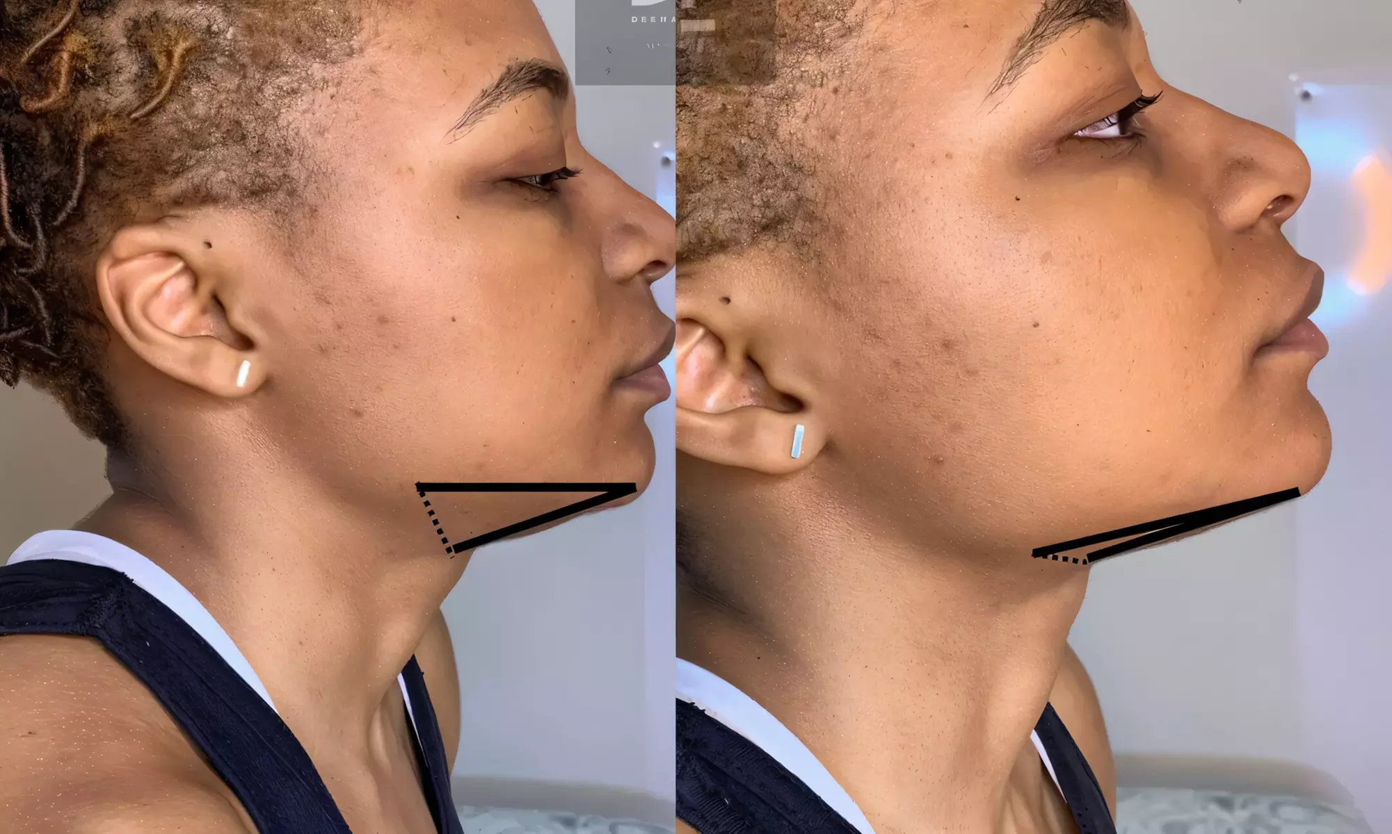 $50 for $100 Toward Body Sculpting & Contouring Treatments