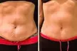 $50 for $100 Toward Body Sculpting & Contouring Treatments - Second Medium