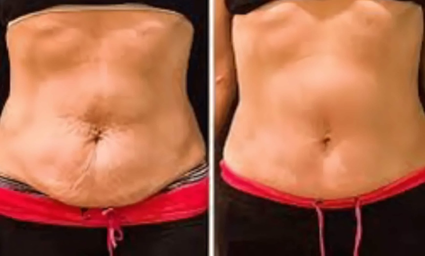 Image 3: $50 for $100 Toward Body Sculpting & Contouring Treatments