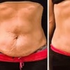 Image 3: $50 for $100 Toward Body Sculpting & Contouring Treatments
