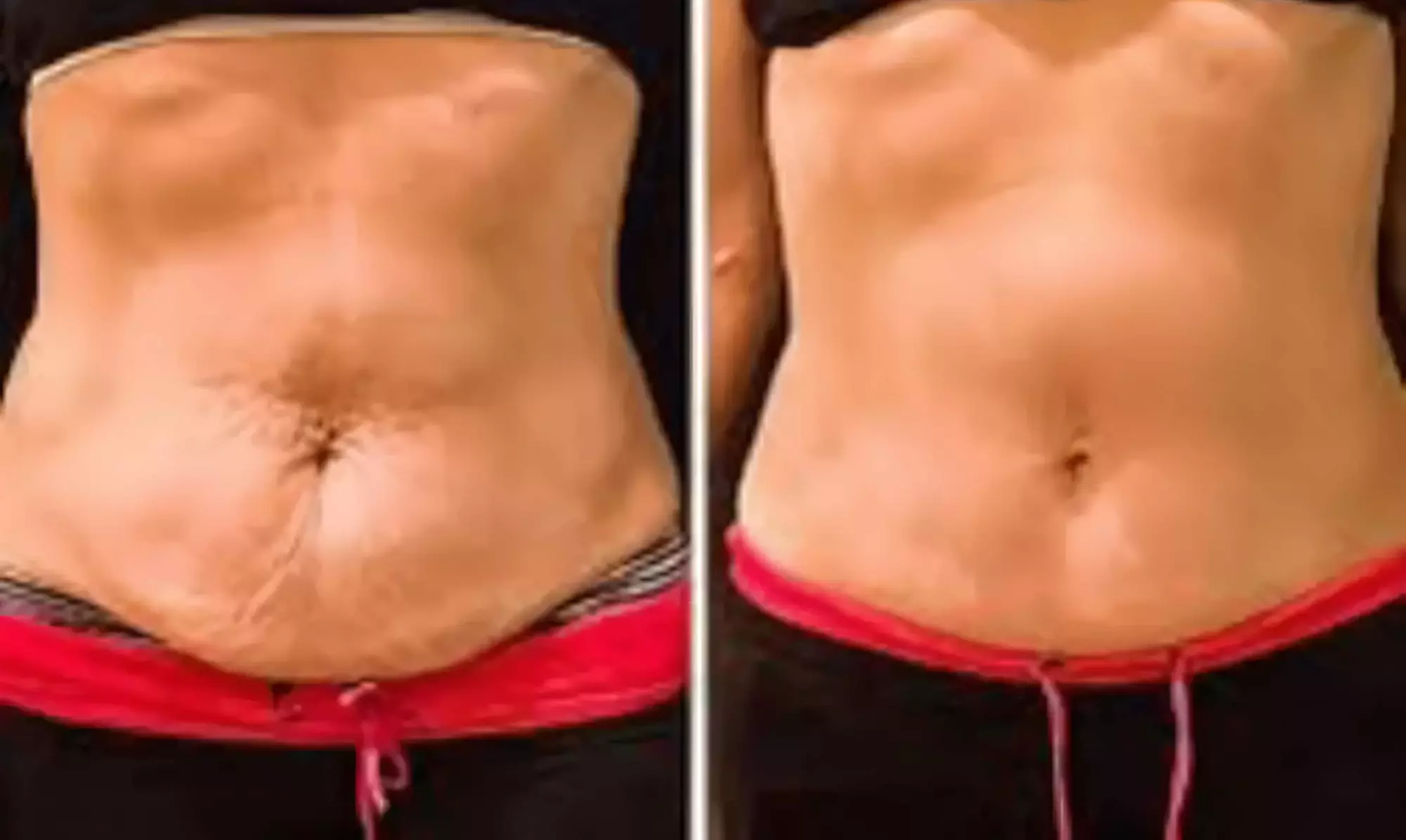 $50 for $100 Toward Body Sculpting & Contouring Treatments