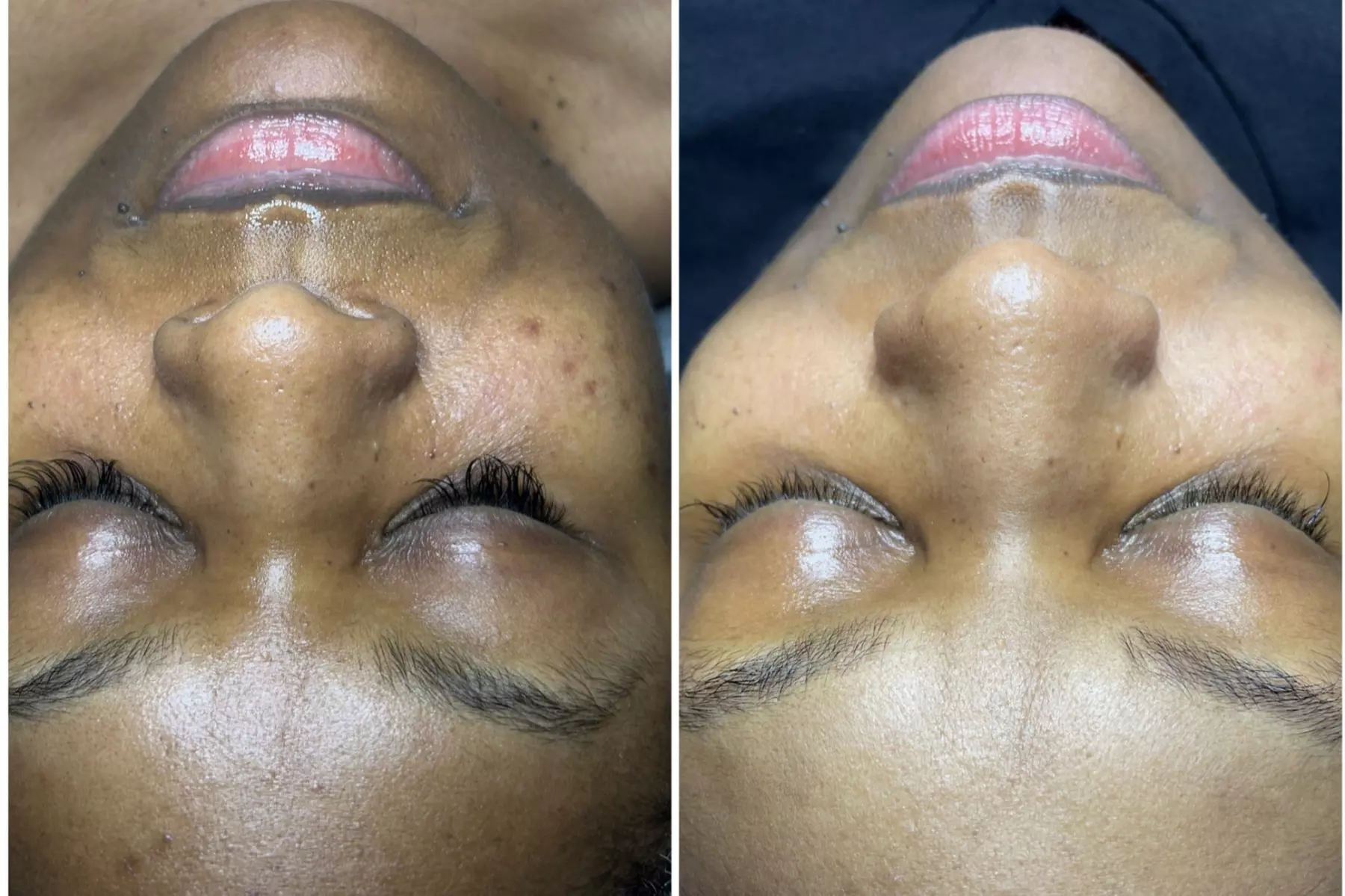 $50 For $100 Towards Facial - Image 3