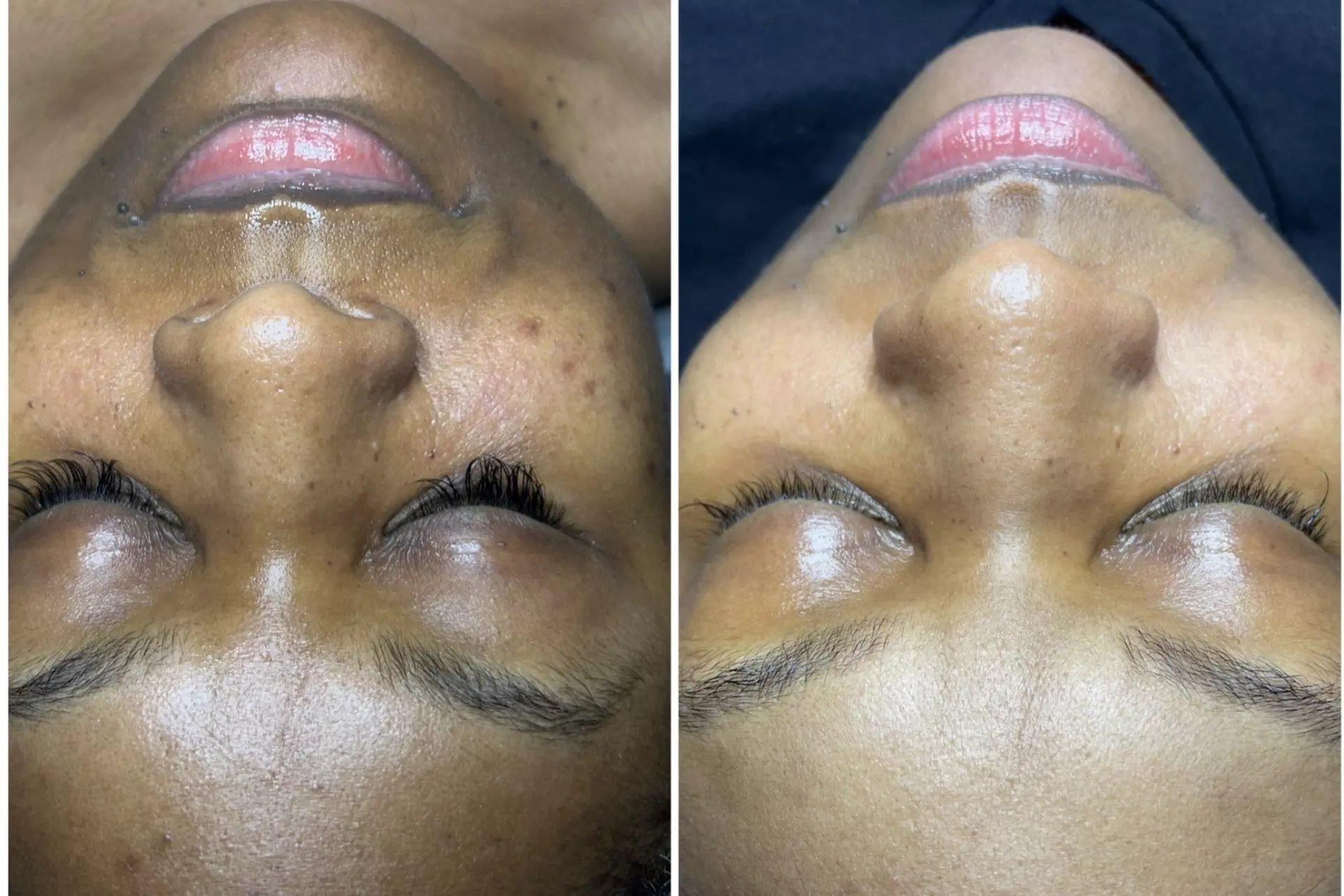 $50 For $100 Towards Facial - Second Medium