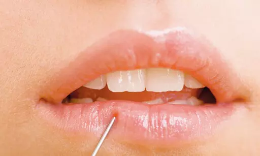 $449 For 1 Juvederm Ultra Injectable Filler W/ Facial Consultation ...