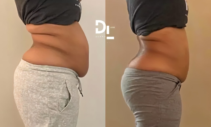 Image 4: $50 for $100 Toward Body Sculpting & Contouring Treatments