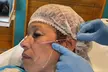 $399 For 50 Units Of Botox/Xeomin Plus 3D Face & Skin Analysis - New Patients Only (Reg. $800) - Second Medium