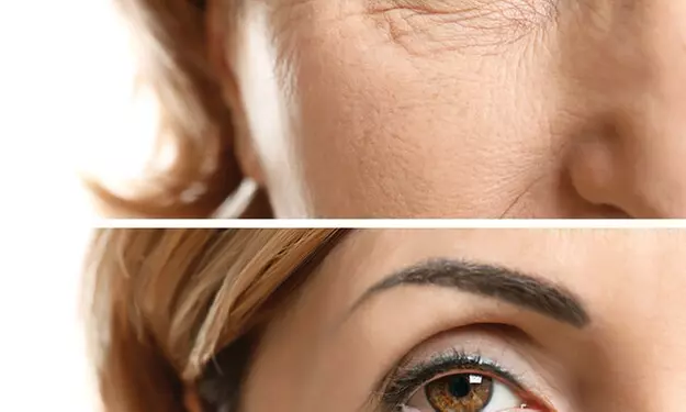 $349 For $700 40 Units of Botox - Second Medium