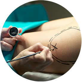 Liposuction