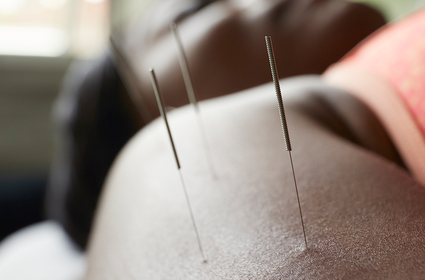 acupuncture