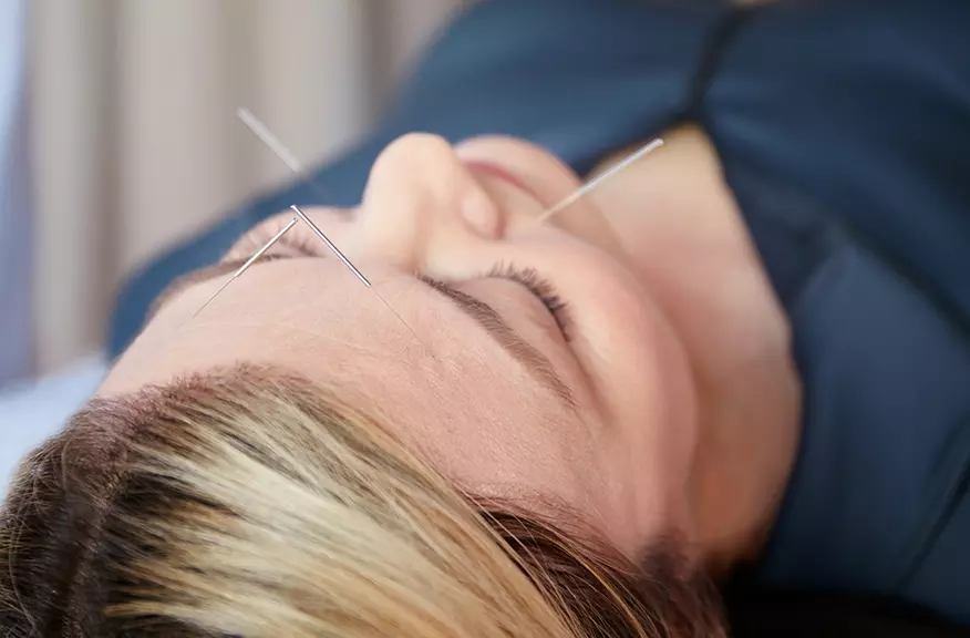 acupuncture head