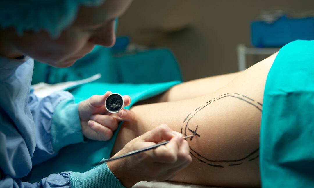 Liposuction Surgery: Preparation, Procedure & Recovery Guide