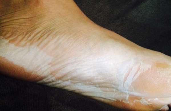 The Truth About Baby Foot Peels