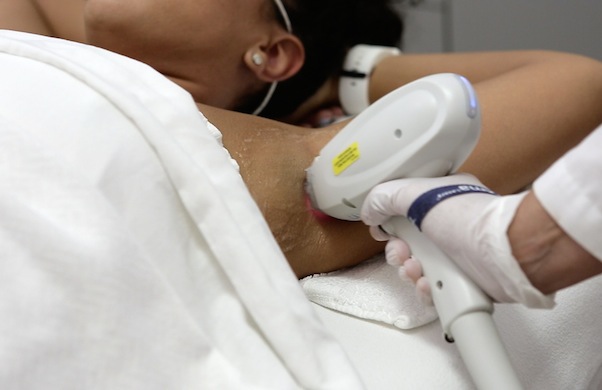 Does Laser Hair Removal Hurt? My Firsthand Experience