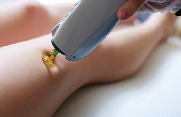 Laser Hair Removal Manchester The Top 5