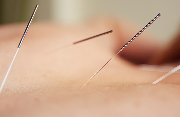 alternativemedicine2k16 ACUPUNCTURE jpg