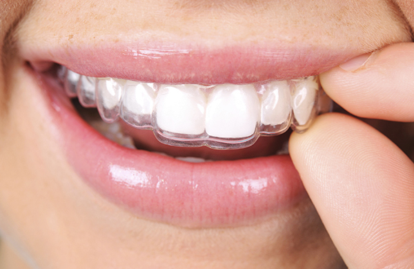 How long does Invisalign take to straighten teeth? - Finsbury Dental Care