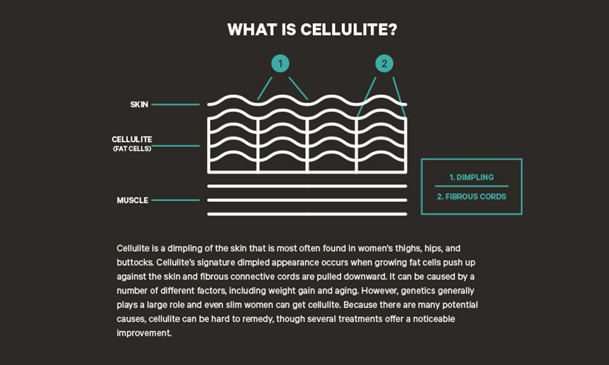 What is Cellulite and Can It be Treated?