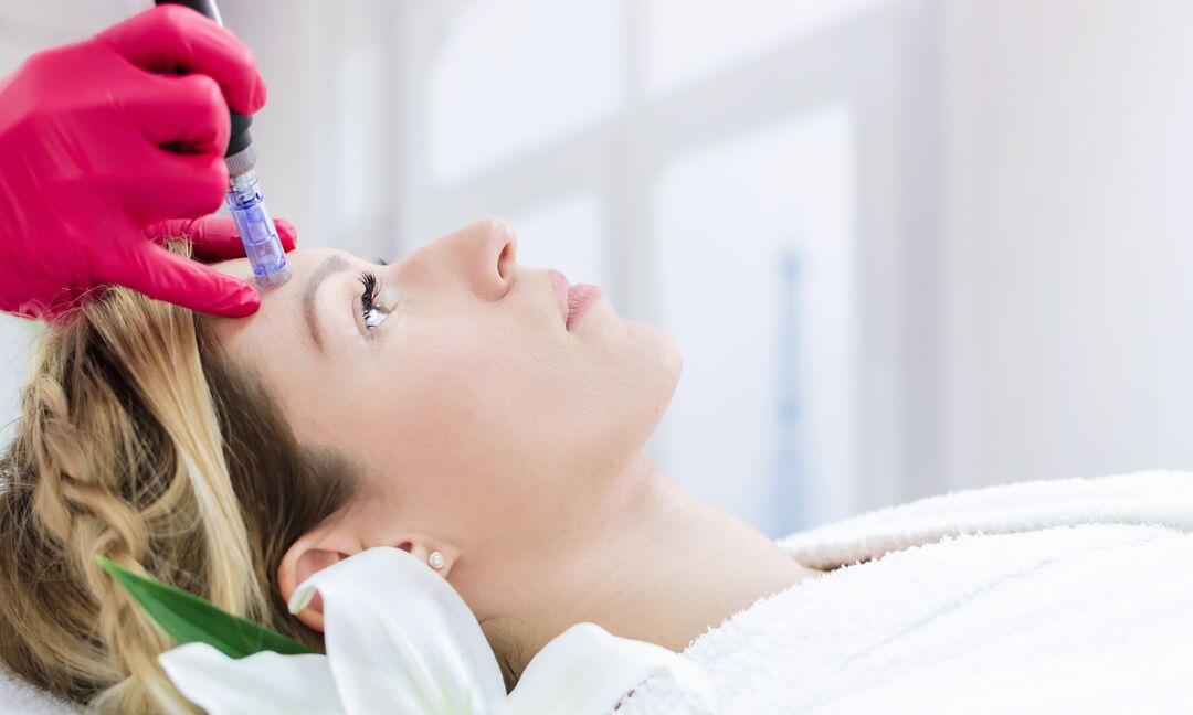 Woman getting a microneedling treatment 