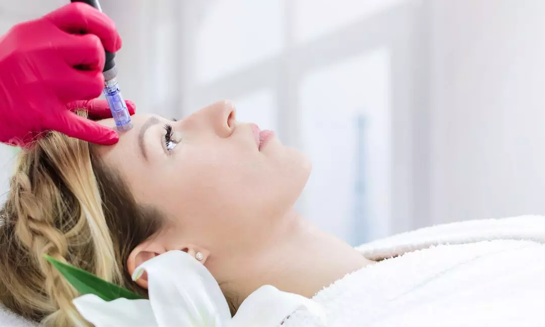 Woman getting a microneedling treatment