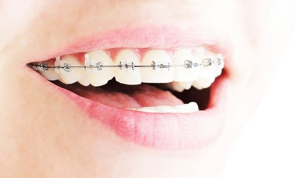 Ortodoncia Brackets Invisalign Y Todo Lo Que Debes Saber Sobre Aparatos Dentales