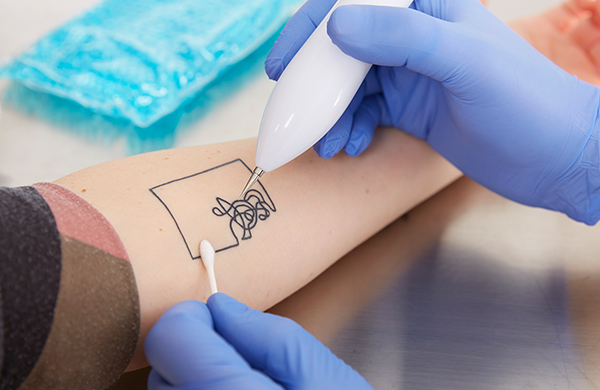 tattoo removal does hurt permanent laser tattoos take remove semi much faqs easily change