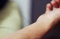 How Acupuncture Fights Allergies