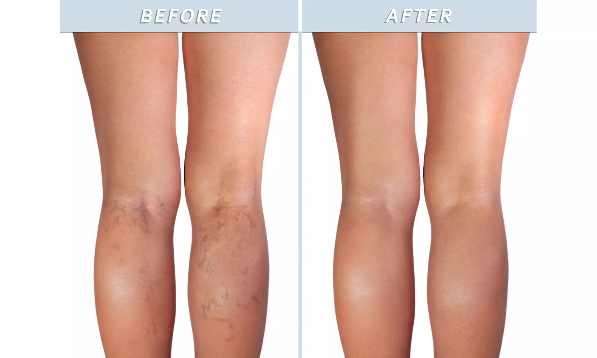 Clearly VEIN, Varicose and Spider Vein Treatment with Horse Chestnut - Second Medium