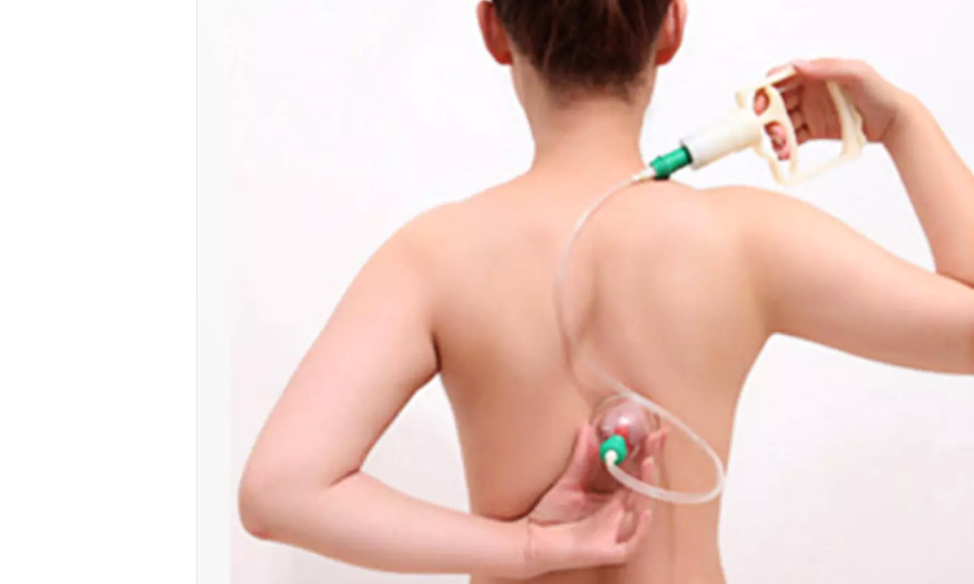 iNova 32-Cup Biomagnetic Cupping Therapy Set for Massage and Body Vacuum Suction