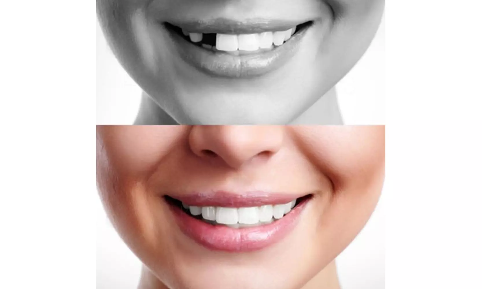 Temporary Tooth Repair Kit Replace Missing DIY Cosmetic Oral Care Make 12 Teeth - Primary Image