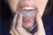 Impressive Mouth Guard - Stop Snoring, Apnea Sleep and Teeth Grinding - Second Medium