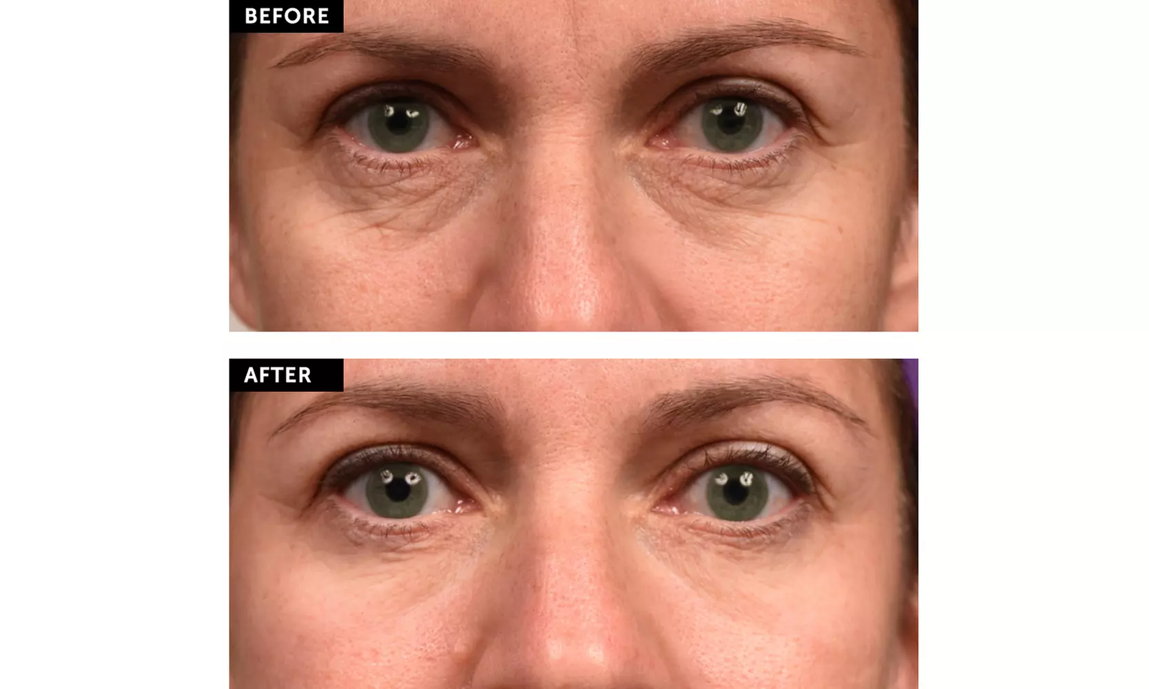 SilcSkin Eye Pads to Smooth away Crow's feet and Bags (15 uses each) - Second Medium