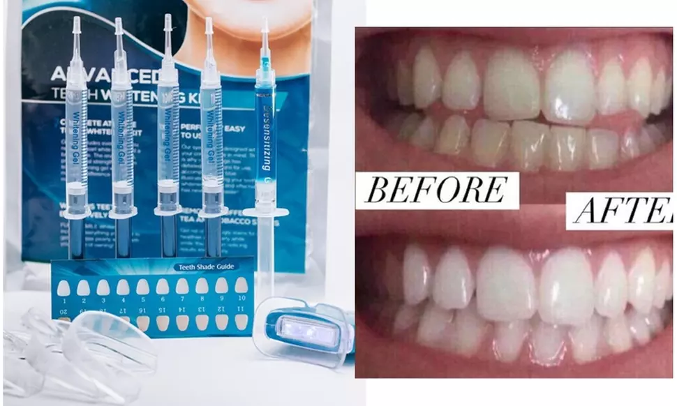 Professional 3D Teeth Whitening Kit w Remineralization Gel: 1 & 2 pack